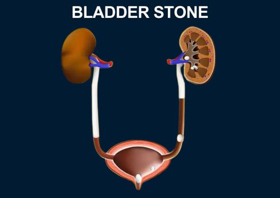 Bladder Stone Treatment in Noida - Dr Dushyant Nadar