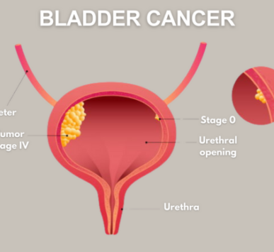 Bladder Cancer Treatment in Noida - Dr Dushyant Nadar