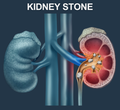 Kidney Stone Treatment in Noida - Dr Dushyant Nadar