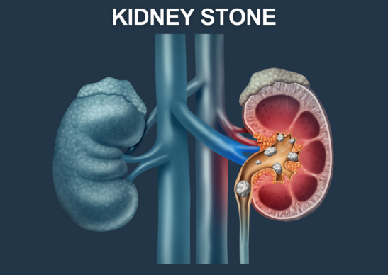 Kidney Stone Treatment in Noida - Dr Dushyant Nadar
