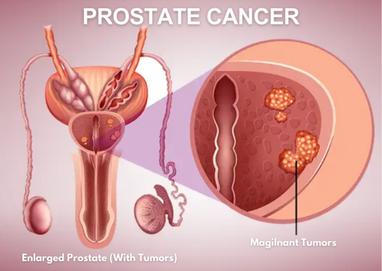 Prostate Cancer Treatment in Noida - Dr Dushyant Nadar