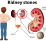 Best Doctor for Kidney Stones Near Me Dr Dushyant Nadar 90x80