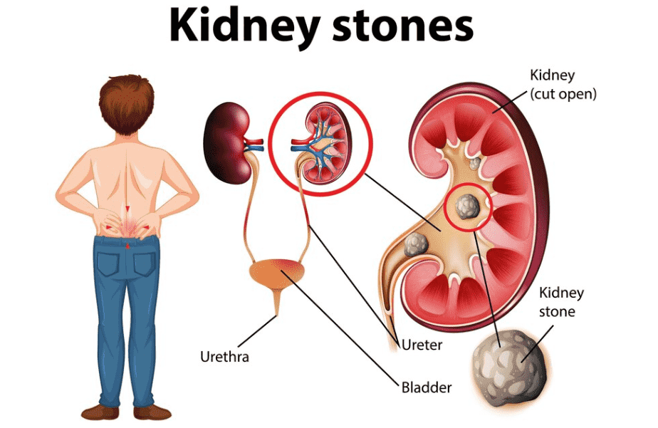 Best Doctor for Kidney Stones Near Me - Dr Dushyant Nadar