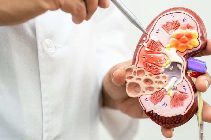 Renal Transplant in Noida - Best Kidney Transplant Specialist