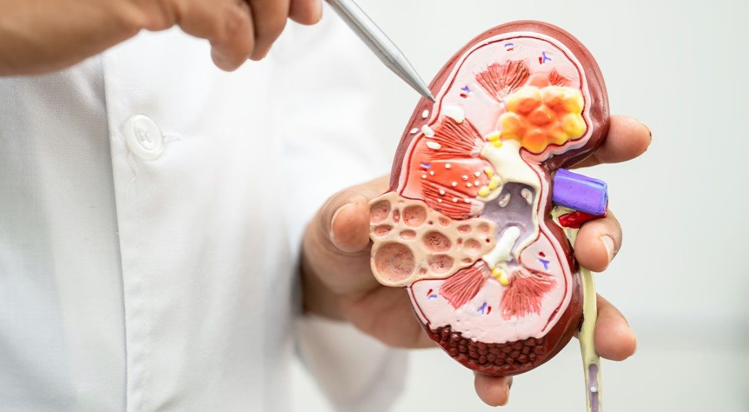 Renal Transplant in Noida - Best Kidney Transplant Specialist